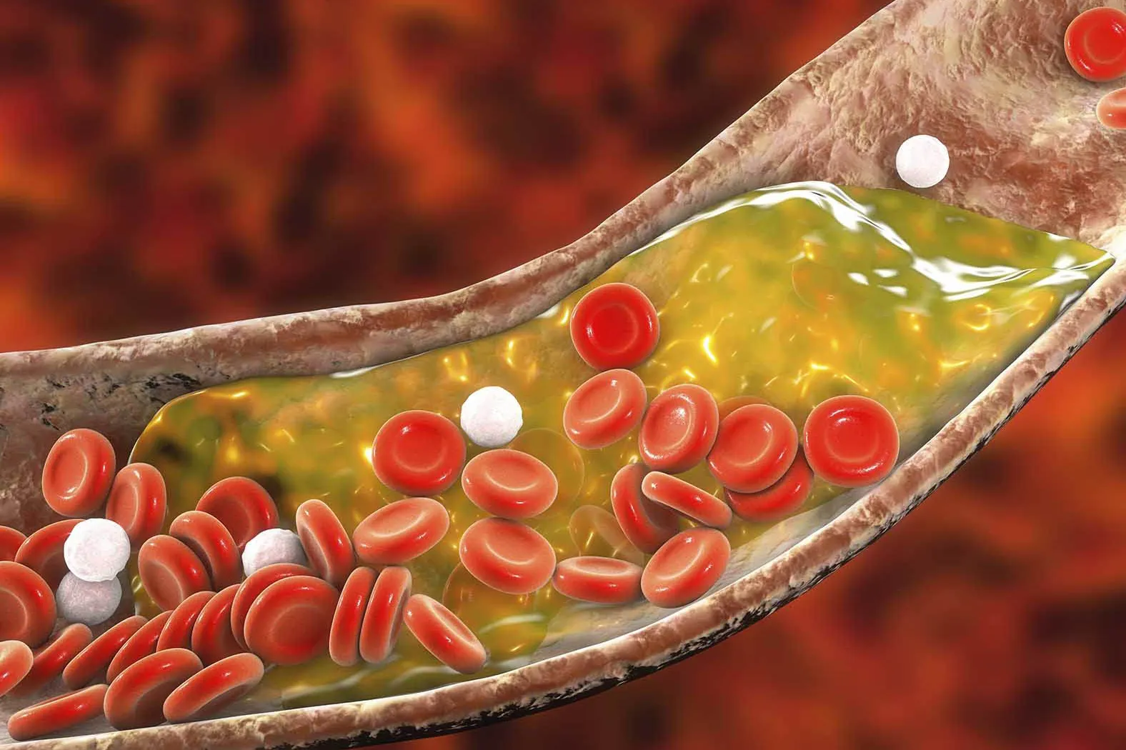 Omega 3 giúp giảm mức cholesterol LDL