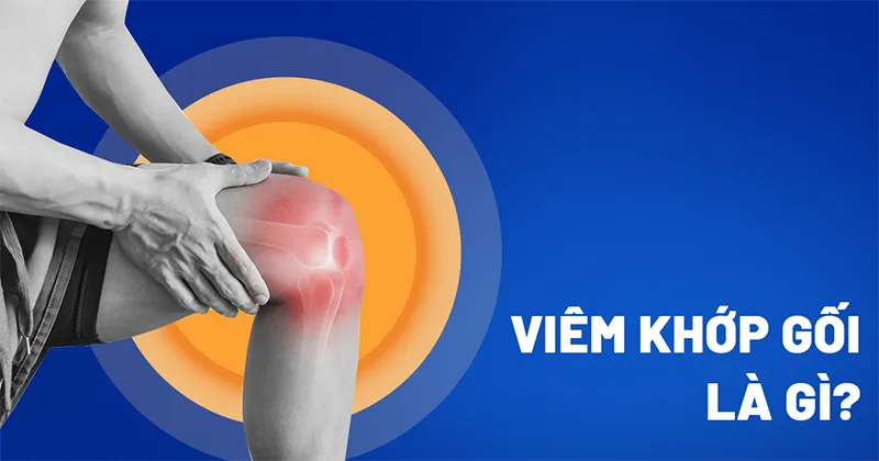 Viêm khớp gối là tình trạng viêm nhiễm ở khớp gối