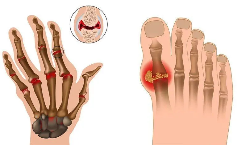Hệ miễn dịch tấn công mô khớp khỏe mạnh, gây viêm màng hoạt dịch