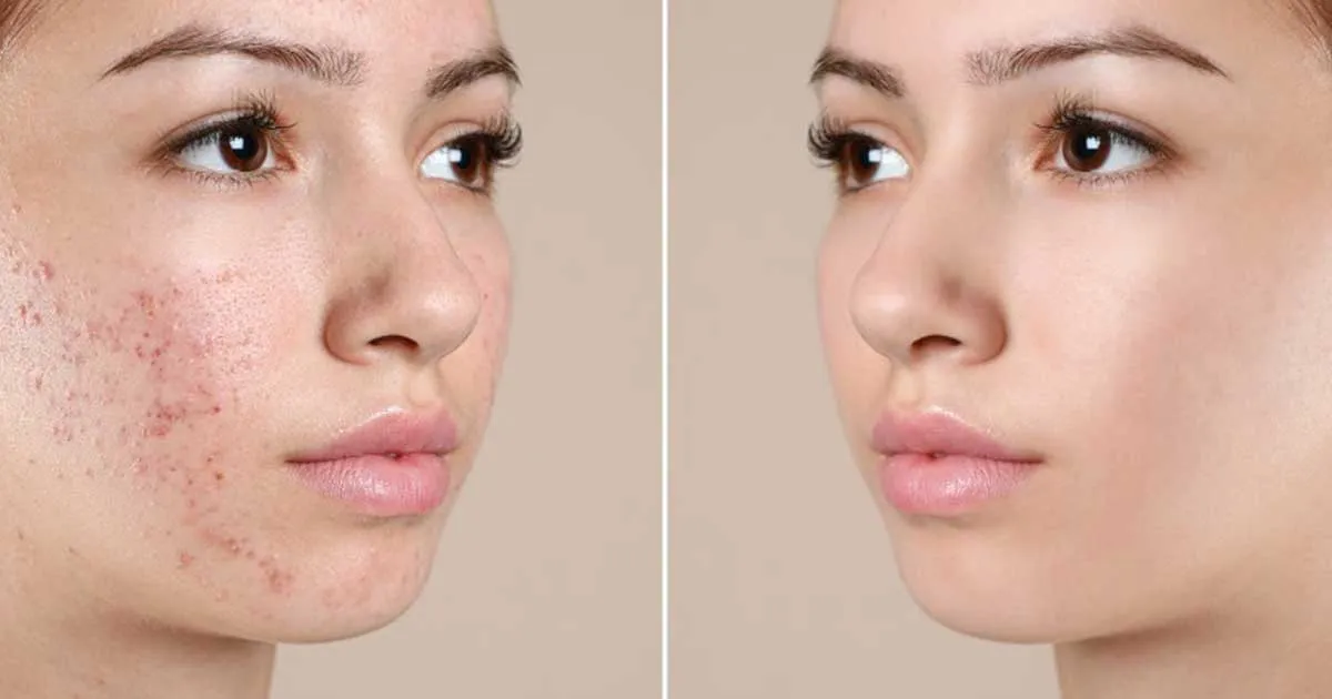 Hỗ trợ giảm các dấu hiệu viêm sưng, ngăn ngừa mụn tái phát 